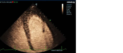 LVO (Left Ventricular Opacification)