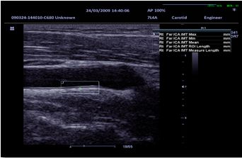 IMT (Intima-Media Thickness)
