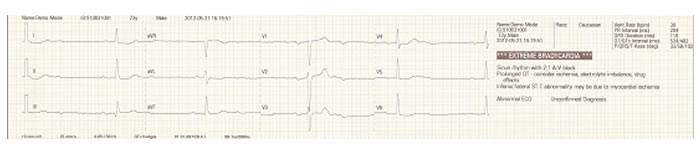 BeneHeart R3 ECG Machine Manufacturers India