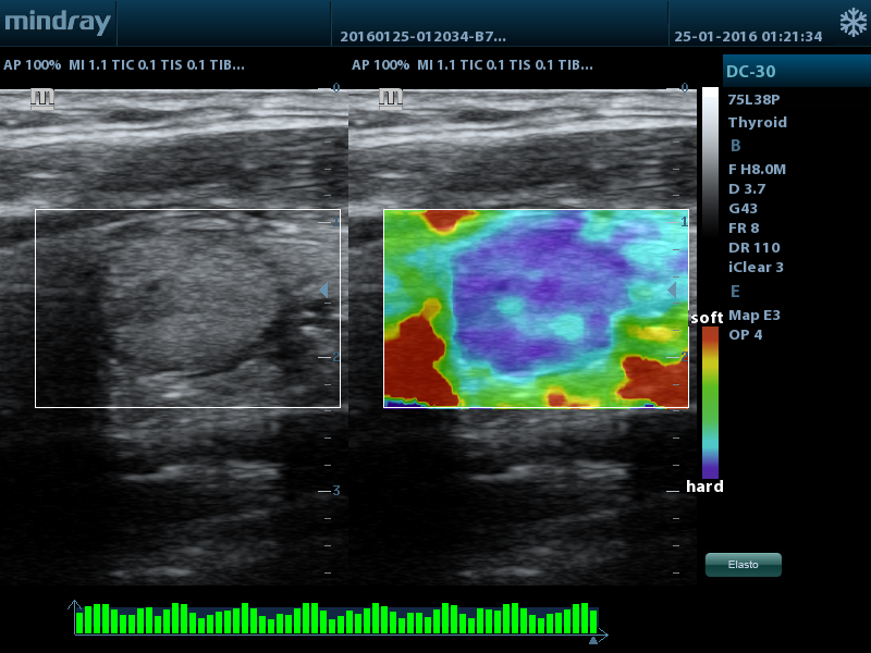 Natural Touch Elastography