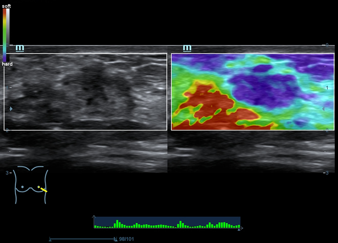 Natural Touch Elastography
