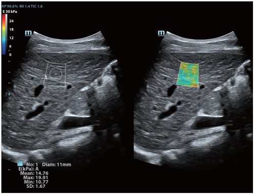 Complete Elastography Solution