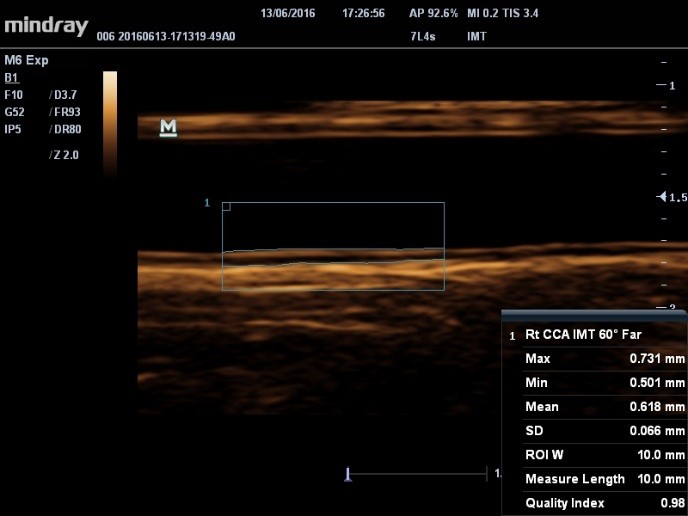 IMT (Intima-Media Thickness)