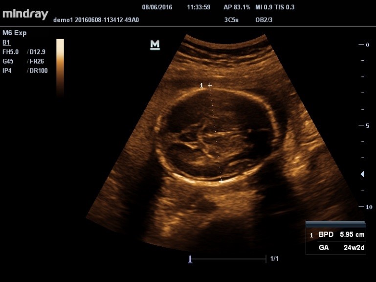 Smart OB