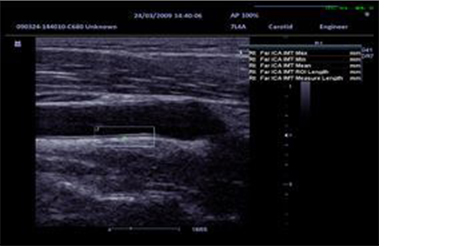IMT (Intima-Media Thickness)