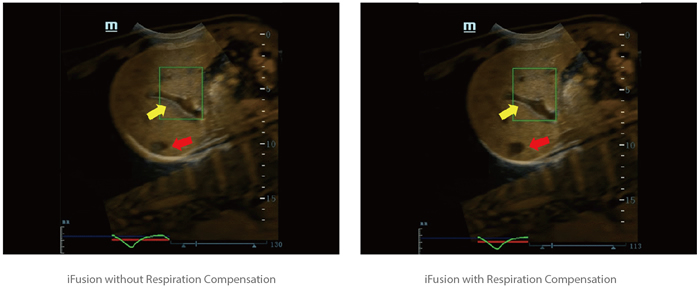 iFusion with Respiration Compensation