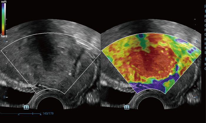Natural Touch Elastography