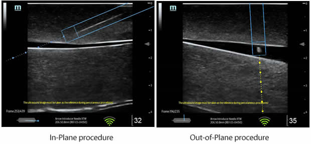 TE5 Ultrasound System Suppliers